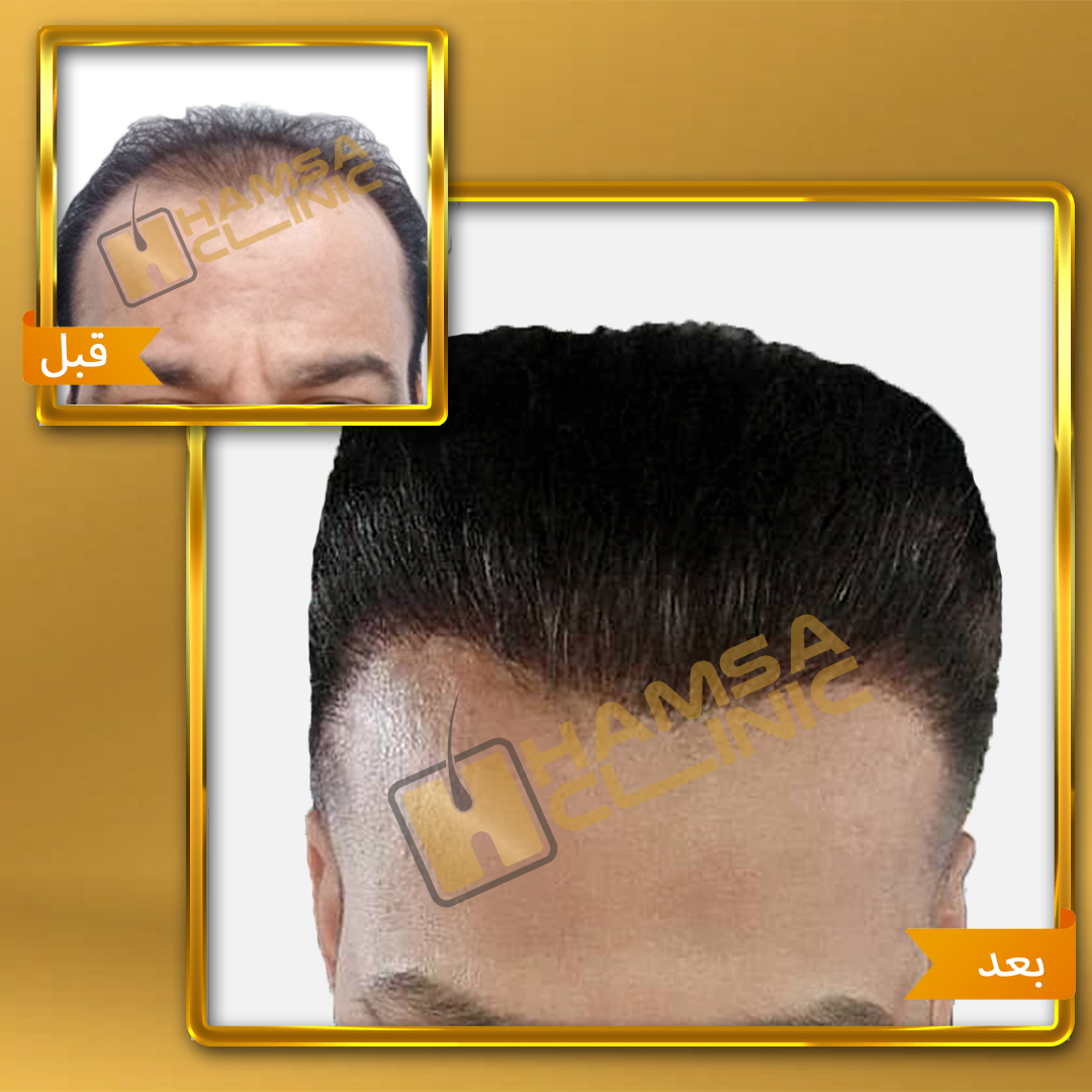 کاشت مو - کلینیک همسا