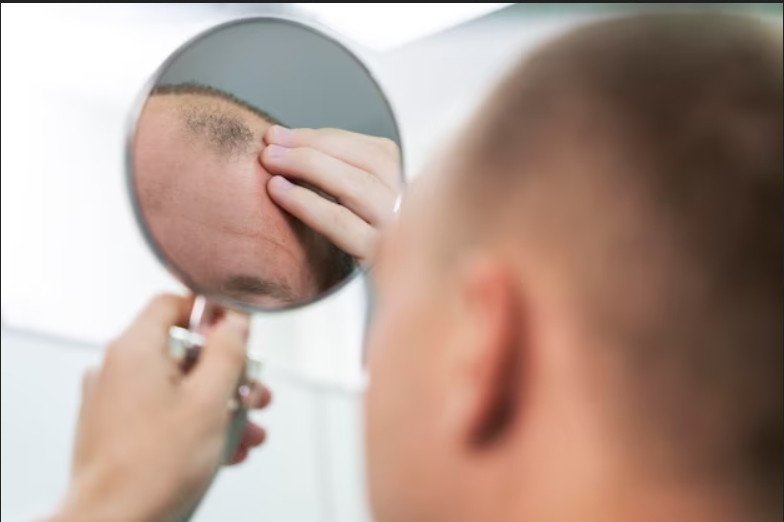 علت ریزش مو بعد از کاشت