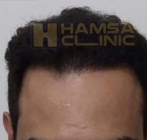 محلول ماینوکسیدیل بر رشد مو