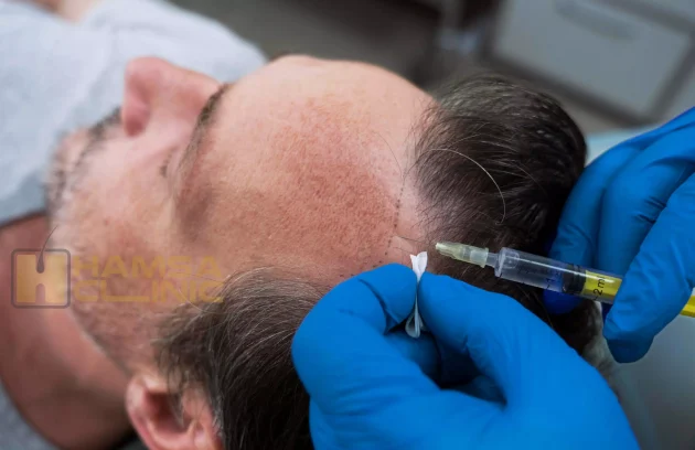 Swelling-hair-transplant