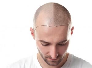 Everything about hair transplant