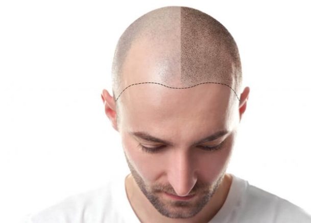 Everything about hair transplant