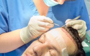 Post-Hair Transplant Care in the Summer