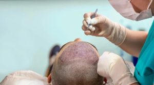 تراکم کاشت مو