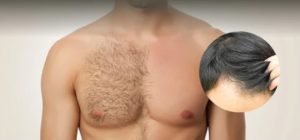 پیوند مو از بدن به سر ممکن است؟