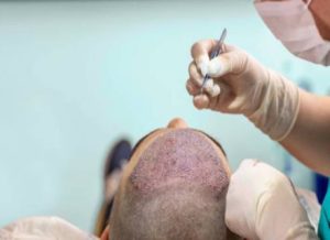 چه چیز هایی بعد از کاشت مو مضر است