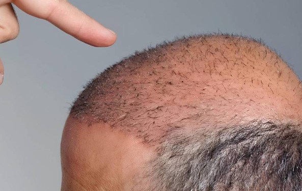 راه‌های ضخیم کردن مو بعد از کاشت