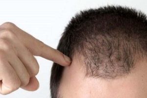 تفاوت کاشت مو در ناحیه جلوی سر و وسط سر