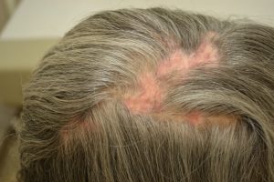 کاشت مو برای افراد با سابقهی لوپوس سیستمی (Lupus) یا بیماریهای خودایمنی